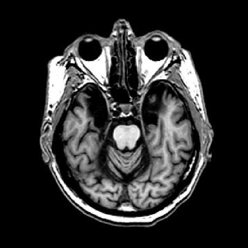 Ein Schnitt durch das Gehirn von Patient H.M. © Suzanne Corkin