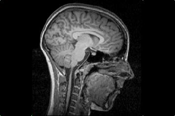 Hirnschnitte einer Anorexie-Patientin (oben) und einer gesunden 16-Jährigen (unten). © B. Herpertz-Dahlmann, Universitätsklinikum Aachen