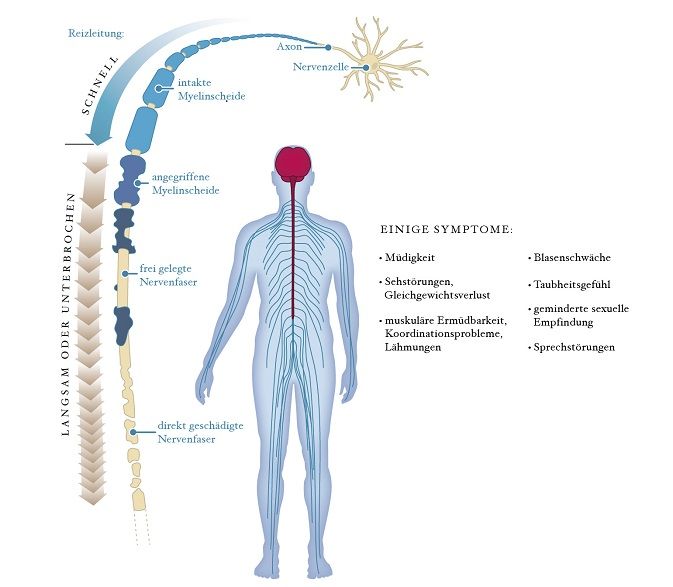 Bei Multipler Sklerose werden im zentralen Nervensystem (rot) die isolierenden Myelinscheiden der Nervenfasern geschädigt – und immer mehr Studien zufolge auch die Fasern (Axone) selbst. So können Signale des Gehirns auf dem Weg durch das Nervensystem verloren gehen. Verschiedene Symptome sind die Folge. © Spektrum der Wissenschaft / emde-Grafik