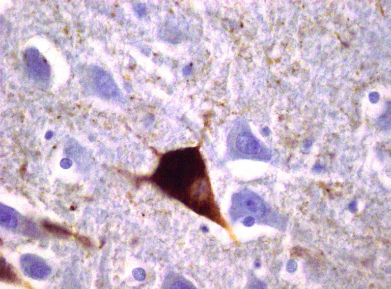 Alzheimer'sche Neurofibrillen